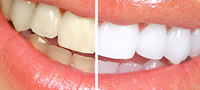 前歯のホワイトニング