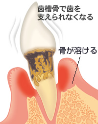 歯周病メカニズム